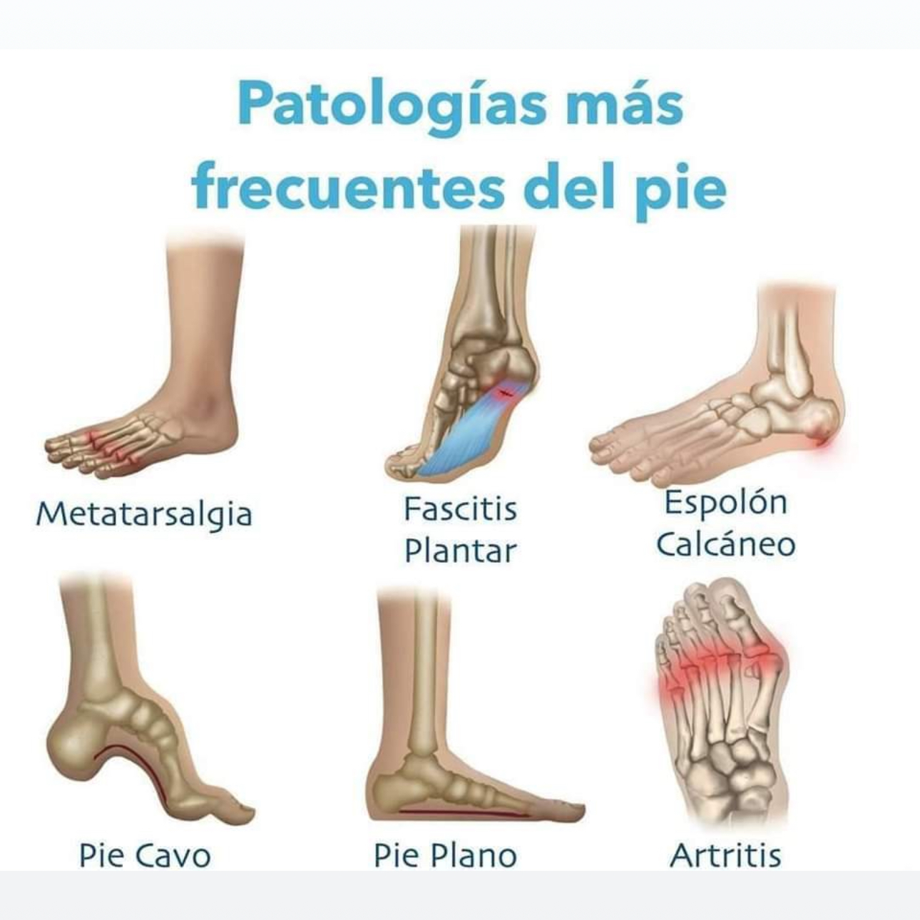 Dolor de pies
