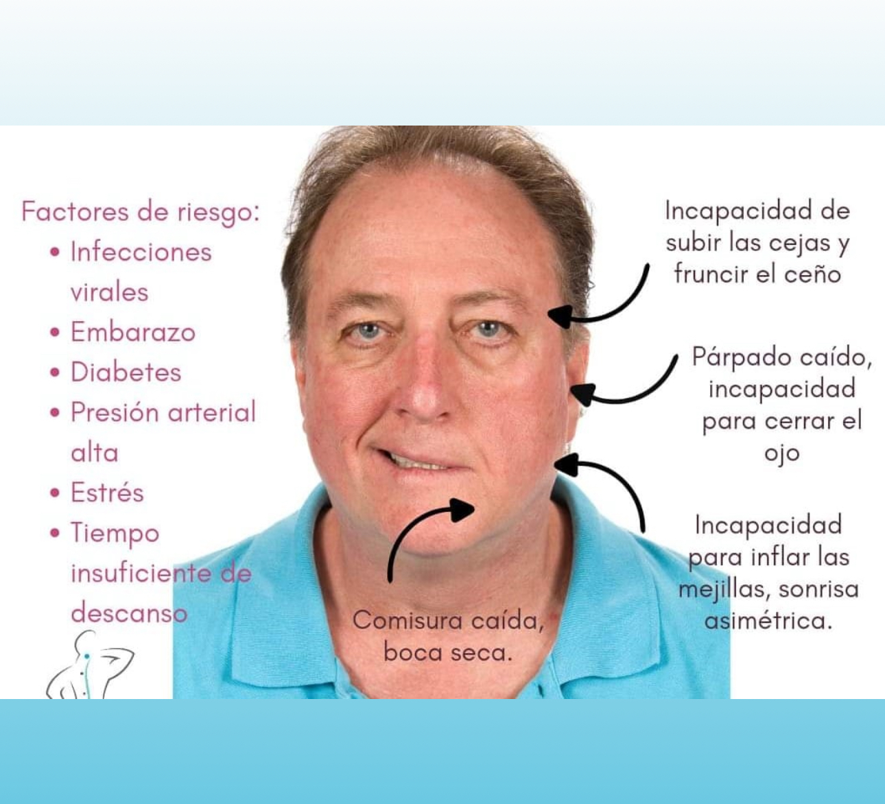 Parálisis facial